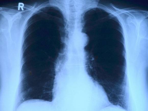 Пневмонию у петербуржцев стали находить в 10 раз чаще