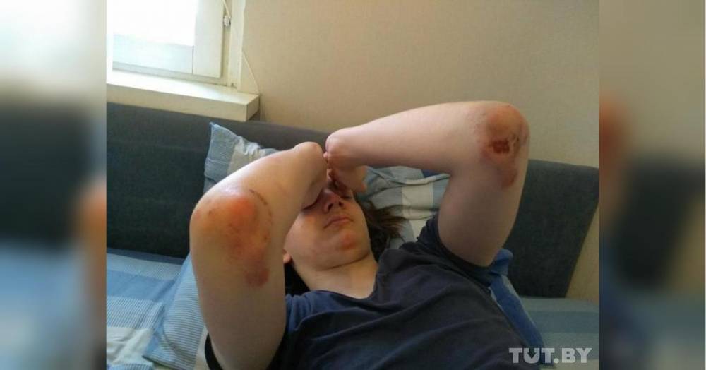 ОМОНовцы трижды избили 14-летнего школьника в Минске: следы от дубинок по всему телу (фото)