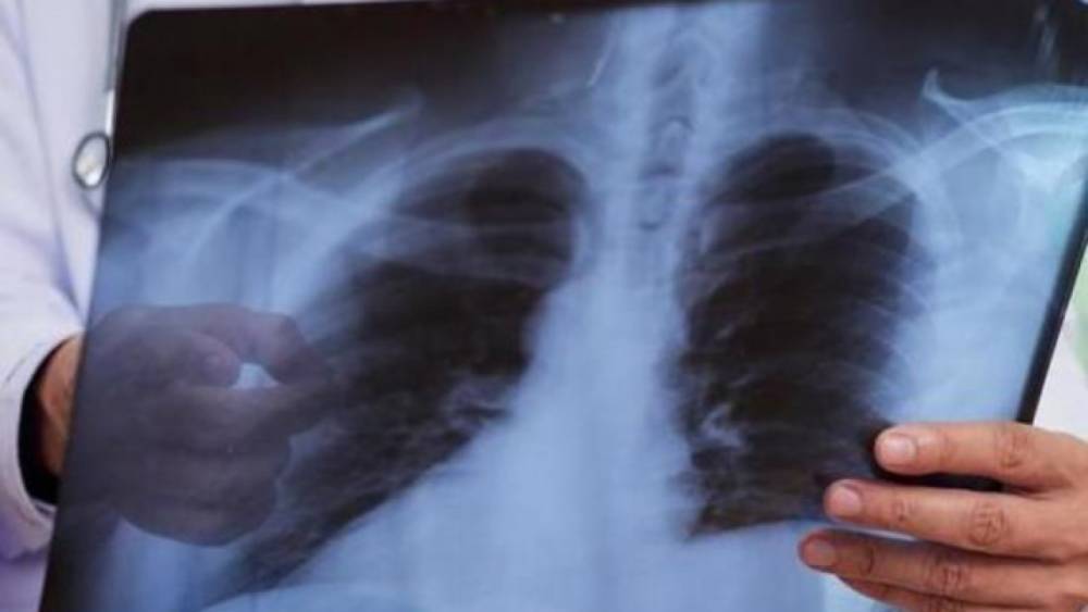 Еще 481 человек заболел пневмонией в Казахстане