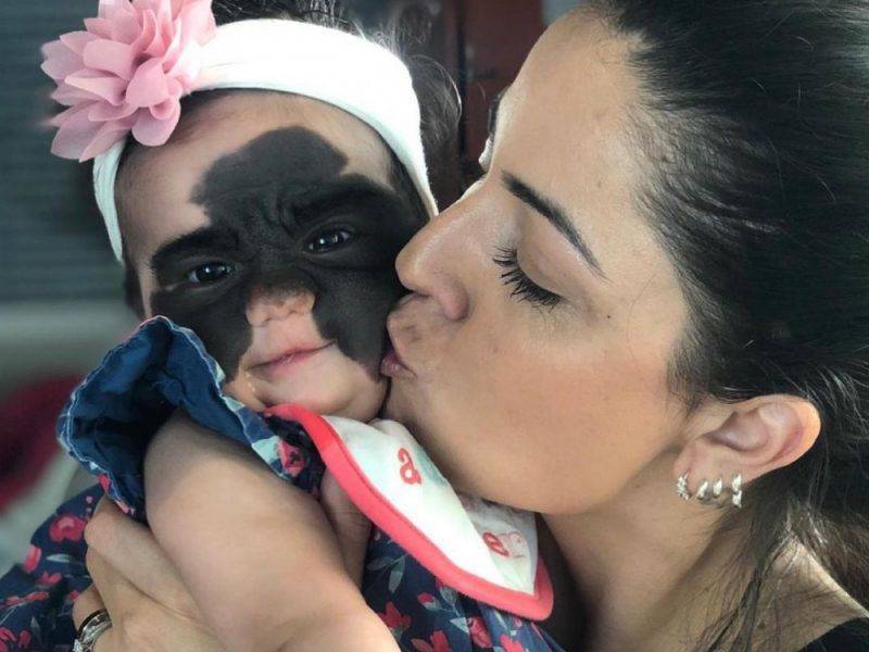 Хирург в Краснодаре удалил огромную «маску Бэтмана» с лица маленькой американки