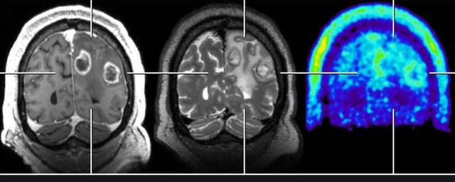 На прогрессирование Альцгеймера влияет появление агрегатов в разных областях мозга