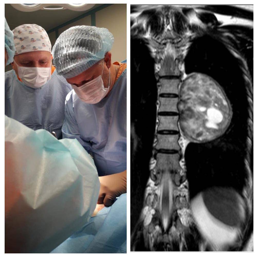 Новосибирские хирурги удалили из груди пациентки опухоль размером с кулак