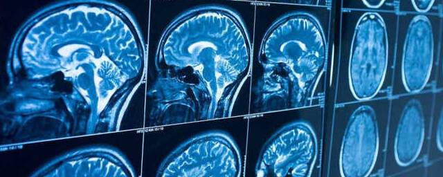 Коронавирус провоцирует тяжёлые нарушения работы головного мозга