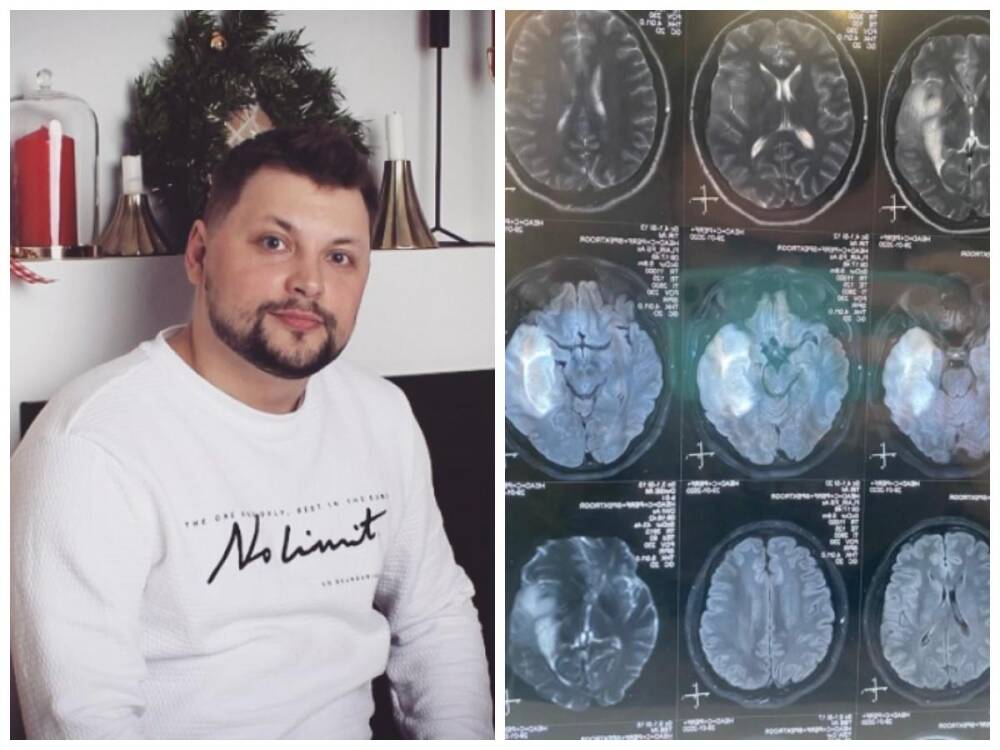 Житель Новосибирска рассказал о жизни после удаления части мозга