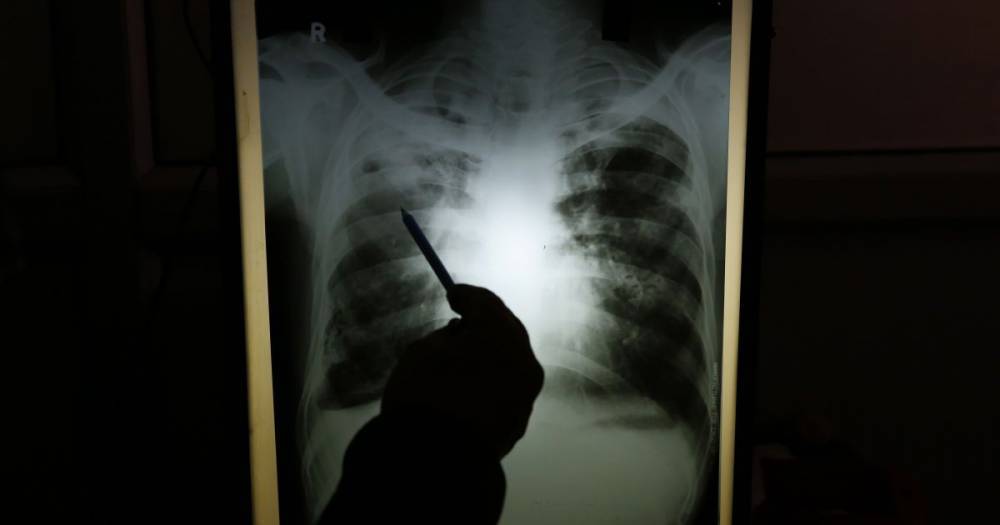 В Украине почти на 30% уменьшилось число случаев туберкулеза: в каких областях больше всего больных