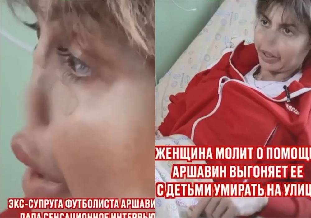 Жена Аршавина лишилась носа из-за аутоимунного некроза и боится повторения судьбы Началовой