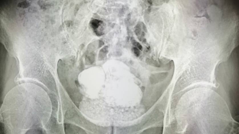 Полкилограмма камней извлекли врачи Ишима из мочевого пузыря пациента