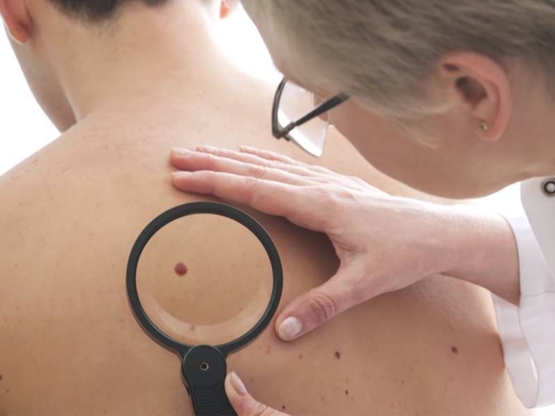 Появление новых родинок и различных пятен может свидетельствовать о раке кожи