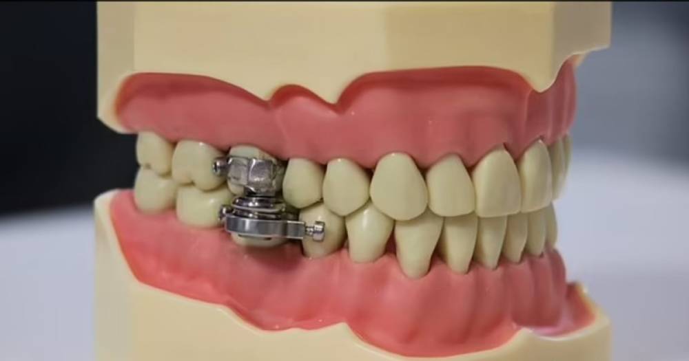 Рот на замок! Ученые создали устройство для похудения, которое крепится на зубах