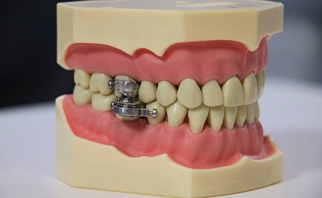 Новое устройство для похудания, ставящее замок на зубы, назвали «механизмом для пыток»