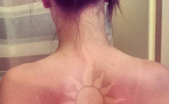 Врачи предупредили об опасности «солнечных татуировок»