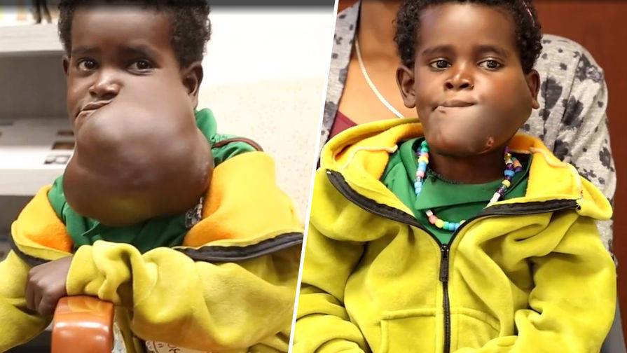 В США врачи удалили опухоль размером с дыню 5-летней эфиопской девочке