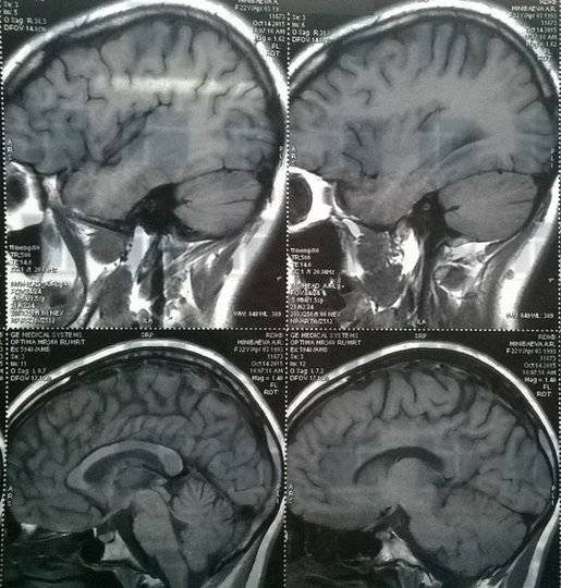 Названы признаки повреждения мозга из-за COVID-19, при которых нужно обратиться к врачу