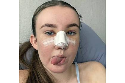 Затравленная из-за формы носа школьница потратила 800 тысяч рублей на пластику