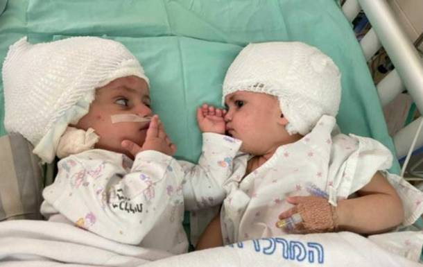 В Израиле успешно разделили сиамских близнецов