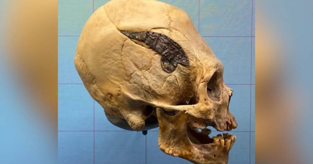 Археологи нашли следы самой первой операции в мире на черепе возрастом 2 тыс. лет (фото)