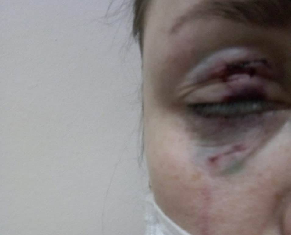 В ХМАО бродячая собака напала на женщину и чуть не лишила ее глаза