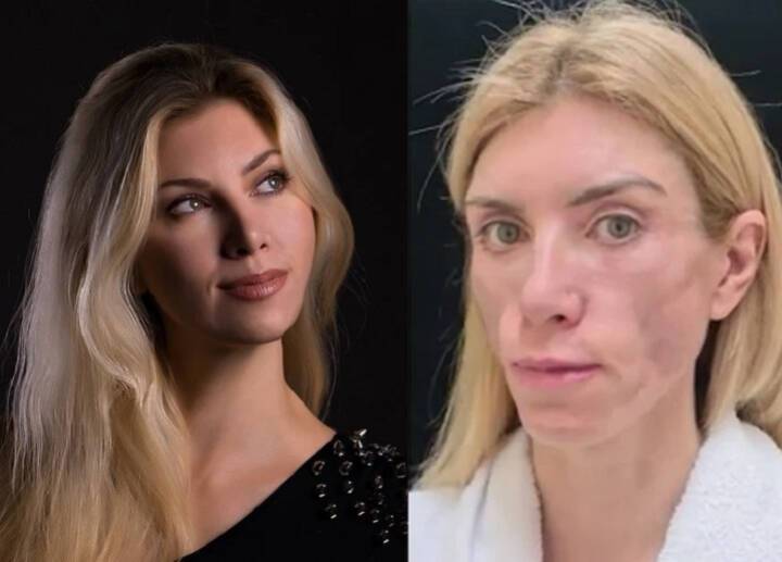 Пластические хирурги изуродовали лицо модели из Сочи и попали под статью