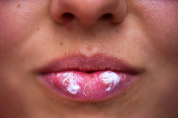 Дерматолог рассказала о пользе зубной пасты при герпесе на губах