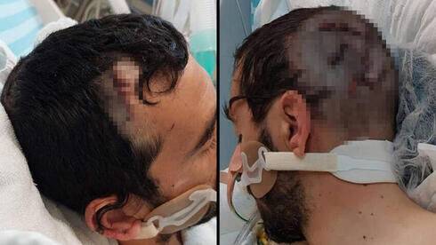 Через 10 дней после теракта: раненный топором в голову Шай пришел в сознание