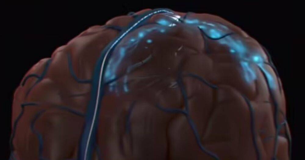 Опережает Neuralink Илона Маска. В США впервые в мозг человека внедрили постоянный имплант