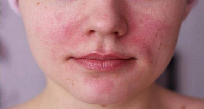 Косметолог поделилась секретом, как спасти кожу лица от перепадов температуры