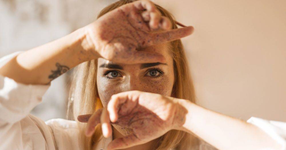 Привет от лета: 3 совета, которые помогут избавиться от пигментных пятен на лице