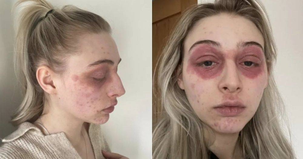 "Как жертва чумы": сильная аллергия на средство для ресниц изуродовала лицо девушки (фото)