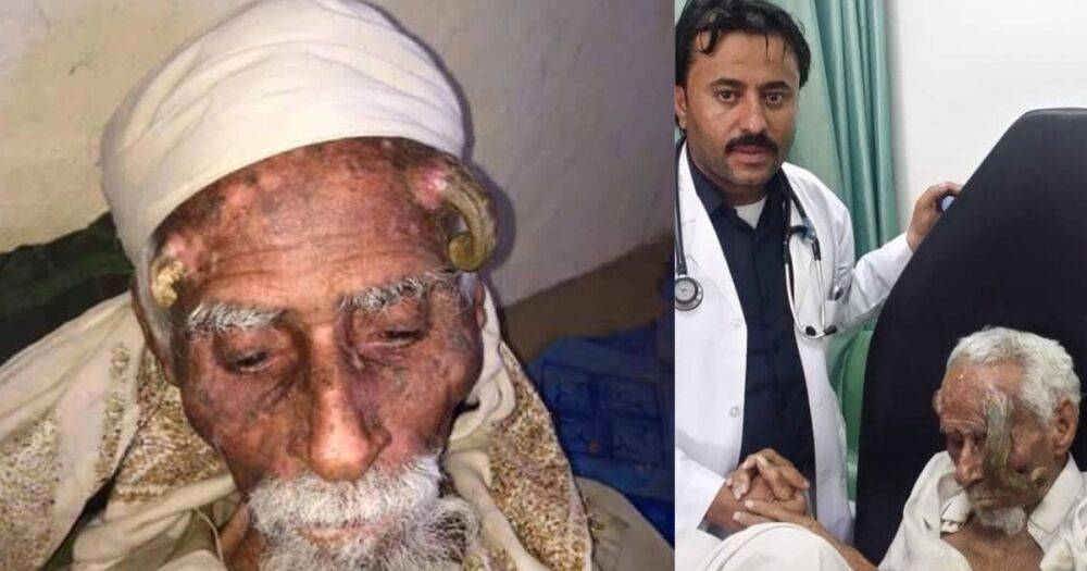 Прозвали "двурогим": в Йемене мужчина умер после неудачной операции по удалению наростов