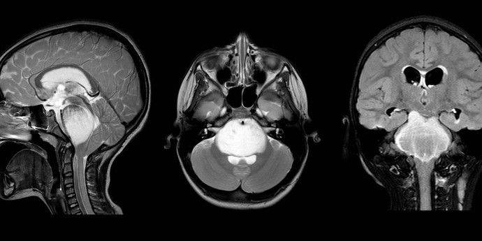 13-летний мальчик впервые в мире излечился от терминальной опухоли головного мозга