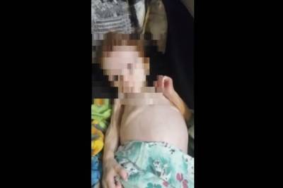 Министр взял под контроль лечение ребенка в шкафу: Состояние девочки стабильное