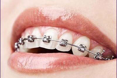 Брекет-системы установит от 40 т. р. стоматолог-ортодонт клиники «Эсси» в Чите