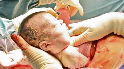 В больнице "Ихилов" прооперировали голову полурожденного младенца
