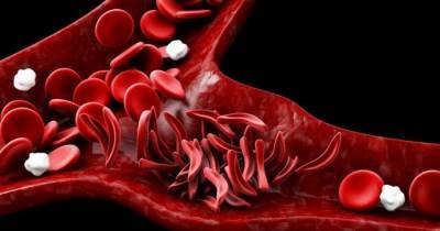 Серповидноклеточную анемию научились выявлять за минуту