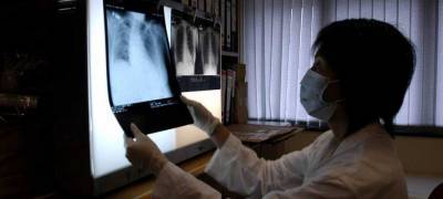 Более полутора тысяч человек госпитализированы в Карелии с внебольничной пневмонией с апреля