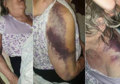В Нижнем Тагиле пенсионерку выписали из «ковидной» больницы с синяками и переломом