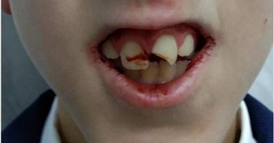 Старшеклассники выбили зубы второкласснику в туалете школы