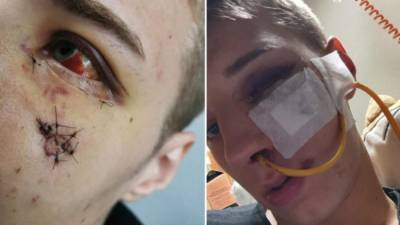 Саар: полицейский-стажер чуть не потерял глаз из-за выстрела в щеку