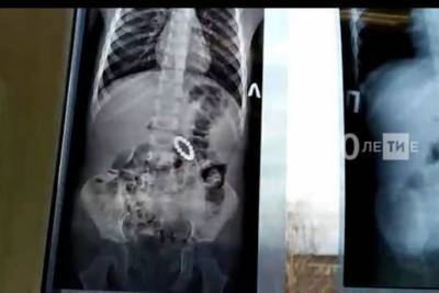 В Нижнекамске врачи спасли проглотившего 15 магнитных шариков малыша