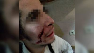 Хасиду в Умани порезали лицо ножом