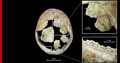 Археологи нашли череп 5000-летнего мужчины со следами операции на мозг