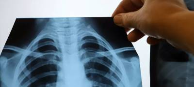 В Карелии еще четверо больных госпитализированы с пневмонией за сутки