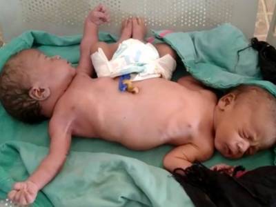 У жительницы Индии родились сиамские близнецы с двумя ногами и четырьмя руками