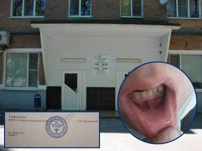 Вырванный по ошибке здоровый зуб мужчине примотали обратно проволокой в стоматологии Волгодонска