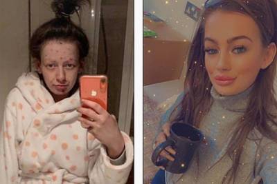 Девушка показала перемены во внешности после отказа от наркотиков
