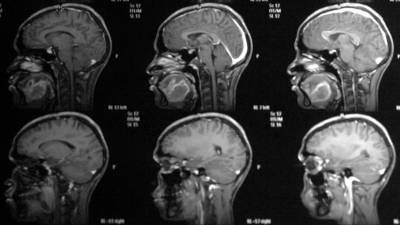Онколог назвал основные симптомы рака головного мозга