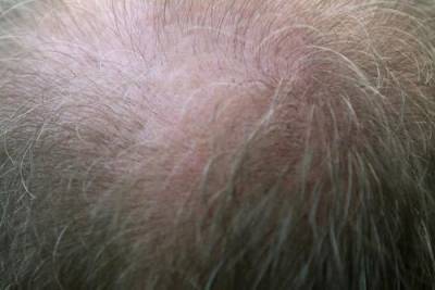 Трихологи Гаджигороева и Ткачев сообщили, что выпадение волос у мужчин не всегда приводит к лысине