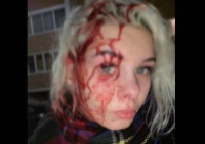 23-летняя рязанка получила страшные травмы на вечеринке