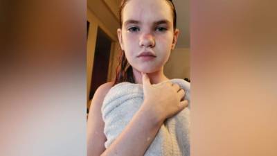 Даже душ может стать для нее смертельным: у этой 12-летней девочки аллергия на воду
