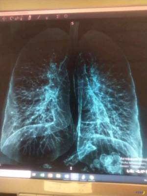 Здоровые лёгкие и тяжело побитые COVID-19 лёгкие